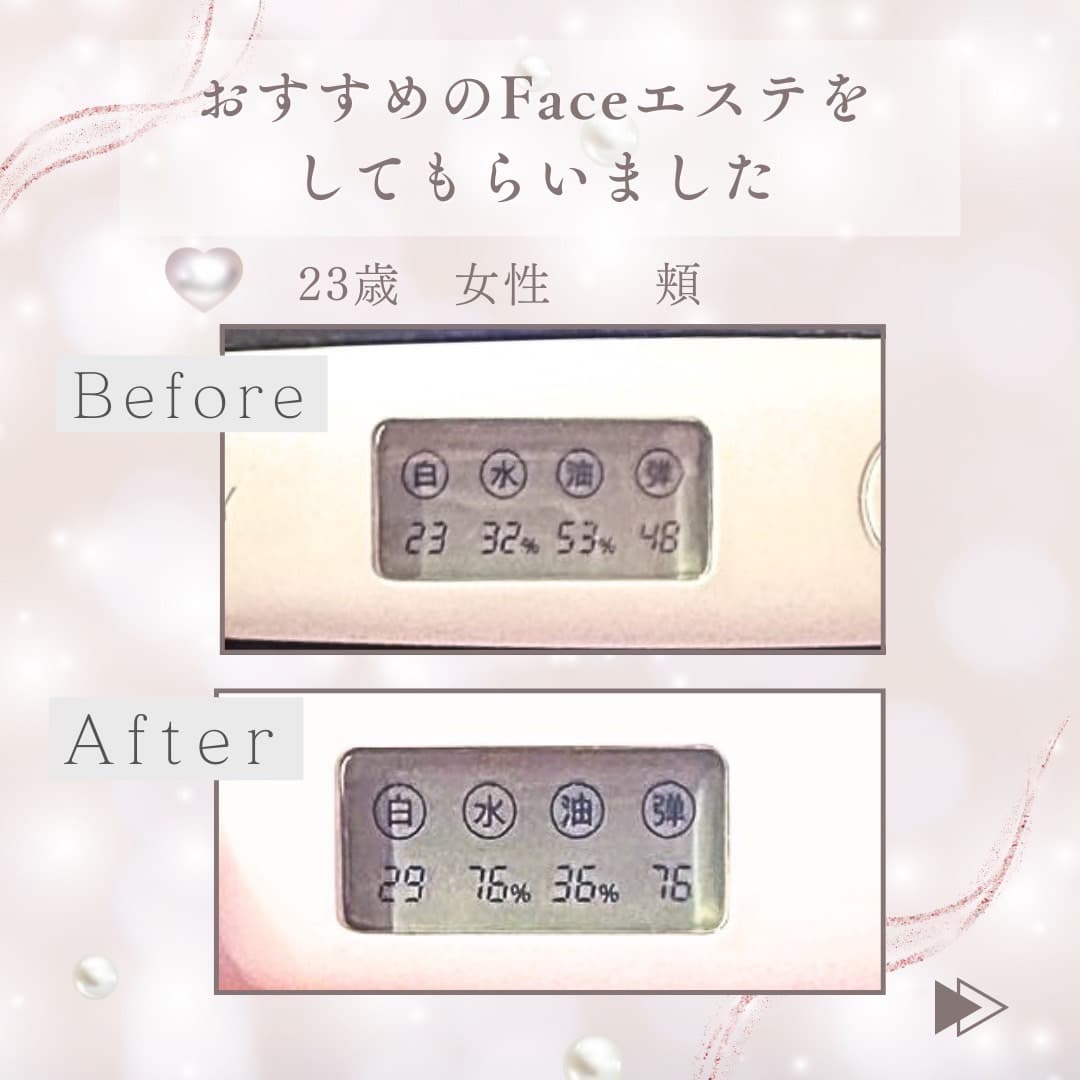 23 歳女性の頬の Before / After 計測スクリーン