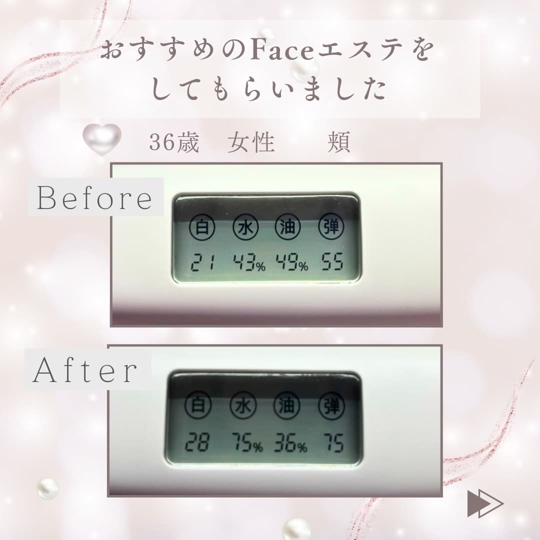 36 歳女性の頬の Before / After 計測スクリーン