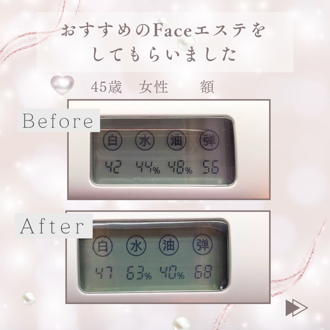 45 歳女性の頬の Before / After 計測スクリーン
